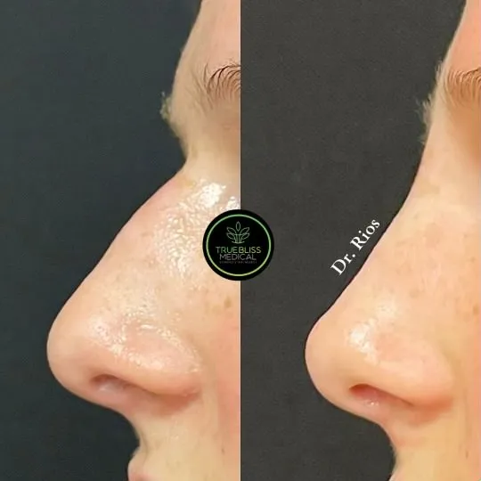 Rhinoplasty before and after