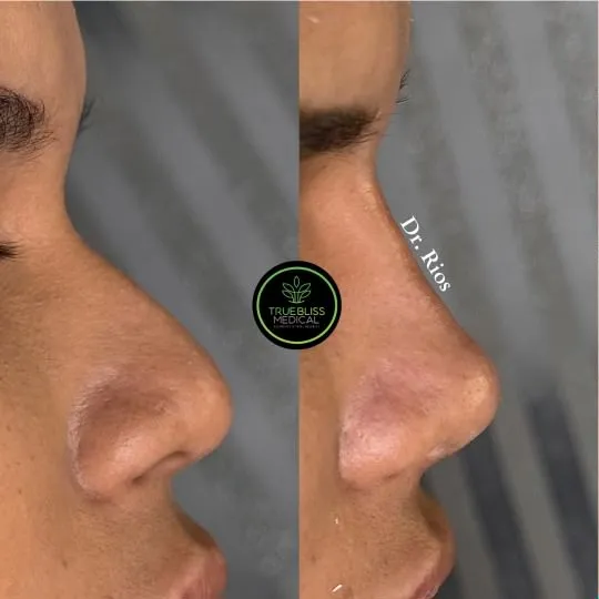 Rhinoplasty before and after